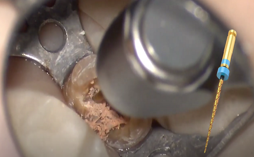 Hyflex Remover Remover A Nice Tool To Remove Gutta Percha Dental