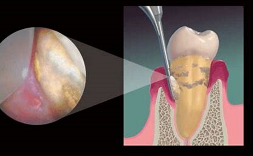 Don’t Get Burned - Keys to Avoid and Remove Burnished Calculus