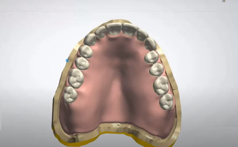 NextDent Denture Workflow with Expert Denturist Germen Versteeg