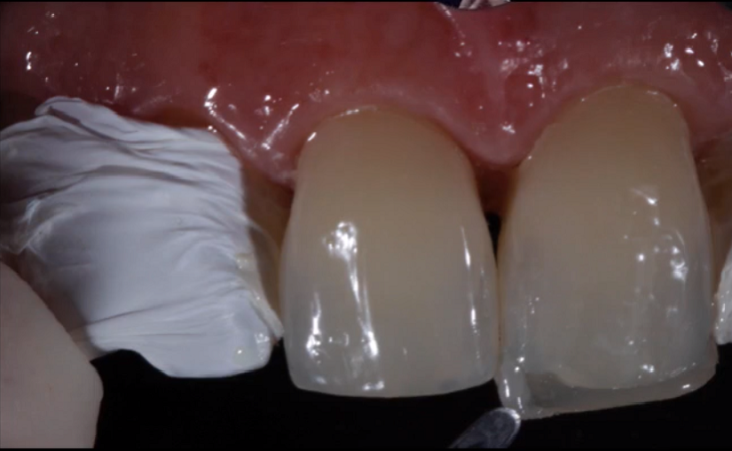 Dr Beolchi on Aesthetic anterior restorations