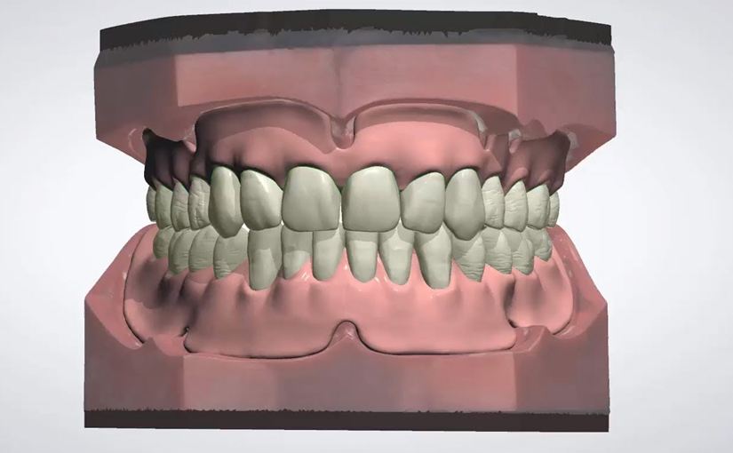 Webinar on Digital Dentures - Everything you Wanted to Know