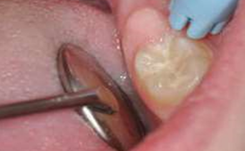 Glass Ionomers Material of Choice in Paediatric Dentistry