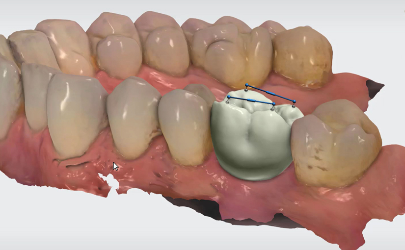 Go Beyond Scanning with Same-Day Implant Dentistry