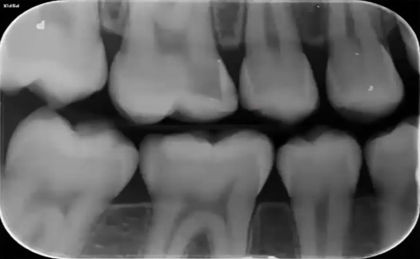 The New (old) Approach to Managing Caries
