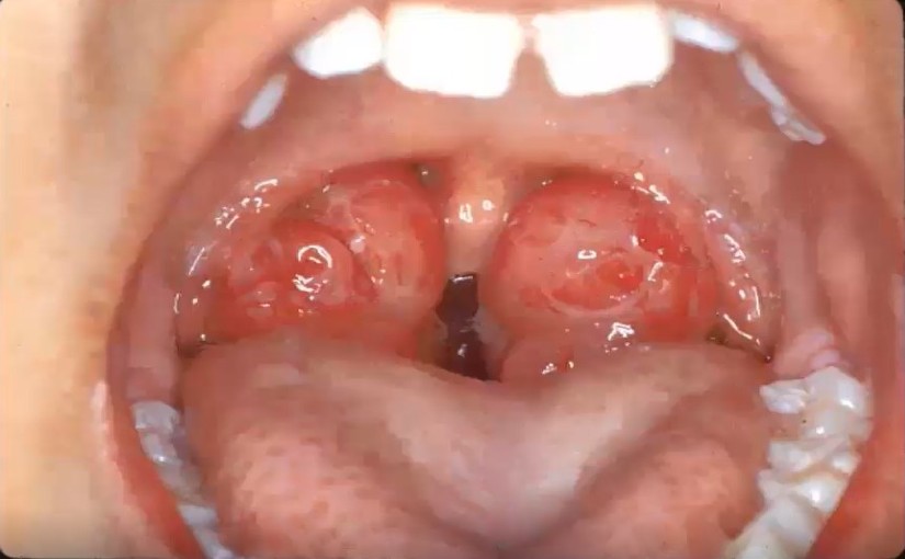 The Crucial Role of Orthodontics in the Multidisciplinary Treatment of Paediatric OSAS