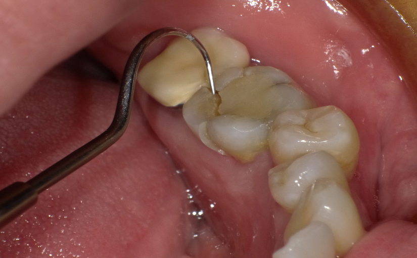 The End is Nigh…or is it? … Reinforcing and Restoring Cracked and Compromised Teeth