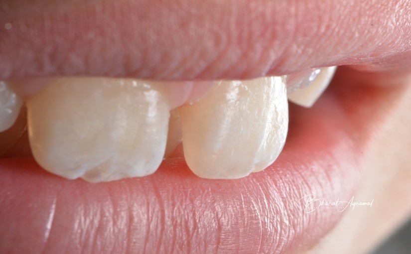Shade, Shape, Texture: The Aesthetic Triad and Direct Composite Restorations