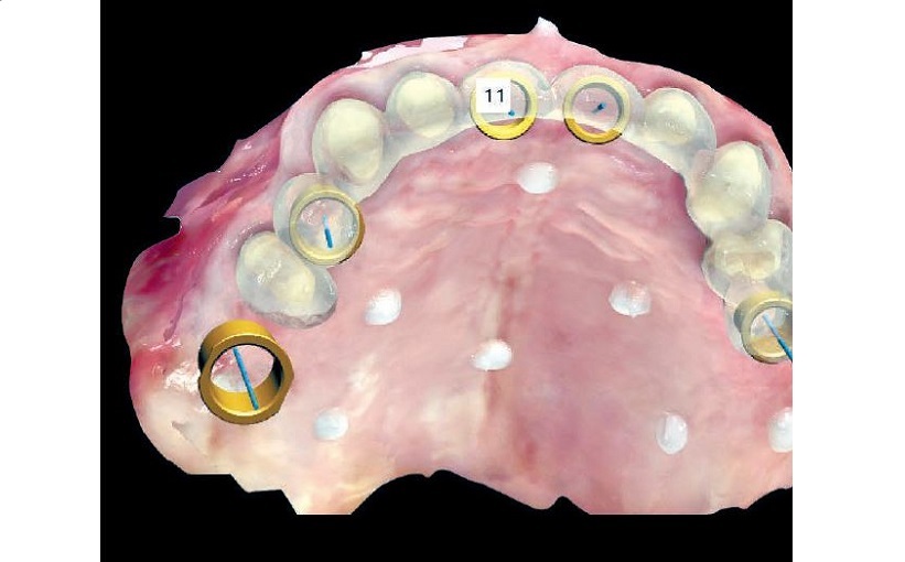 The Full Digital Workflow In Implant And Restorative Dentistry - Dental ...