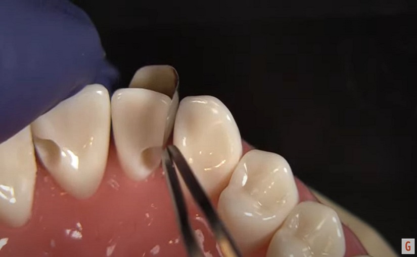 Tips for Using the NEW Fusion Anterior Matrix System for Deep Restorations with Dr. JD Corey