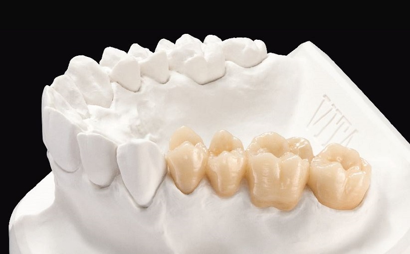 Characterising and Finishing of Chairside Crowns for Predictable Results
