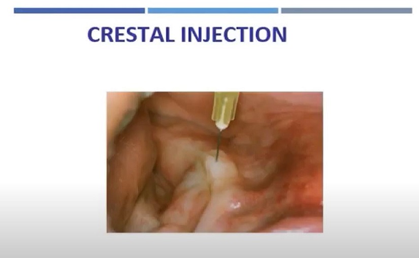 MLSS - Crestal Injection with the STA System (Wand STA)