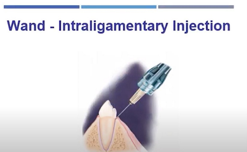 MLSS - Intraligamentary Injection with the STA System (Wand STA)