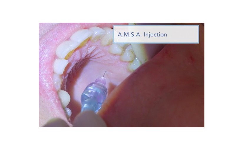 Clinical Technique - Single tooth and AMSA palatal injection